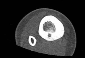 Noncontrast CT scan of the right ankle: oval lytic lesion measuring 5 × 8 mm in the posteroinferior cortex of the right tibia with reactive sclerosis, suggestive of osteoid osteoma.