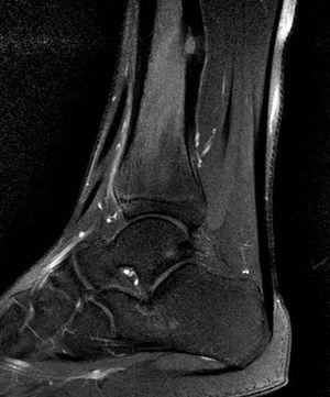 Noncontrast MRI of the right ankle: intracortical lesion in the posterior margin of the distal tibial metaphysis with periosteal thickening and bone edema, consistent with osteoid osteoma.