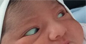 Moment when the patient exhibited horizontal saccadic eye movements.