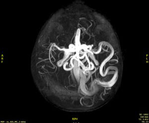 Magnetic resonance angiogram showing a post-rolandic fistula, with MCA and ACA afferents and the ingurgitated venous efferent towards the superior sagittal sinus.