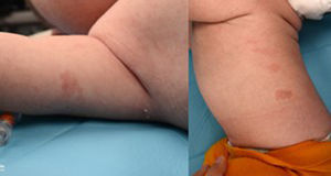 Vascular lesions in the upper extremity and thorax.