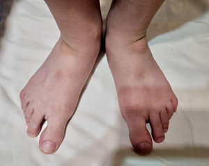 Bilateral hard and hyperpigmented masses in the dorsal aspect of the foot.