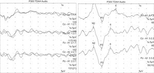 P300 cognitive evoked potentials. The image on the left shows the responses to the frequent stimulus. The image on the right shows the responses to the target or infrequent stimulus, where the P300 wave is recorded.