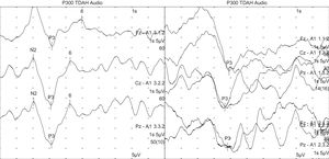 Comparison of P300 responses from a subject with ADHD (left) and a control subject (right). The P300 latency is visibly delayed in the subject with ADHD, although there was no clear difference in amplitude.