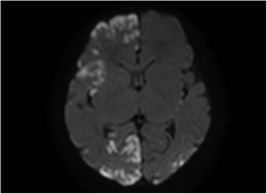 Bilateral patchy involvement at the cortical level on diffusion-weighted imaging.