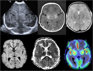 (A) Transfontanellar ultrasound performed on the first day of life in a full-term newborn with severe hypoxia-ischemia showing bilateral central gray matter injury (arrows). (B) Head MRI performed 4 days post birth showing bilateral central gray matter injury in T1- and T2-weighted images, with restricted diffusion and evidence of increased perfusion in arterial spin labeling (arrows), which has been associated with a poor prognosis.