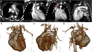 Computed tomography images of patient 2. (A–G) Left pulmonary artery (LPA) originating from the main pulmonary artery (PA). (D–G) Patent ductus arteriosus (PDA) communicating the PA with the descending aorta (DA). (E–G) Volume-rendered images show the anomalous origin of the RPA from the ascending aorta (AAo) with an interrupted aortic arch. (C, E, G) Small right pulmonary artery (RPA) (red arrow) originating from the ascending aorta (AAo).