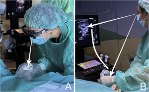 Comparison of the operator’s visual axis (white arrows) when performing ultrasound-guided cannulation with augmented reality glasses (image A) versus a conventional ultrasound display (image B).