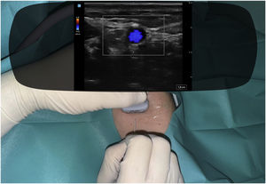 Photomontage showing the operator’s field of vision during the ultrasound-guided cannulation procedure with the smart glasses connected to the ultrasound machine via a data cable.