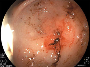 Central pylorus with edema and obstruction impeding passage of the 9.9-mm endoscope.