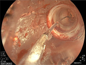 Pyloric dilation with a 12-mm hydrostatic balloon.