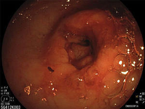 Pylorus following endoscopic dilation, allowing passage to the duodenum.