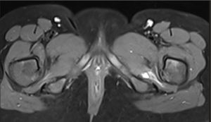 Bilateral diffuse muscle edema in the quadratus femoris muscle.