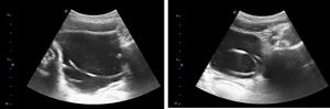 Point-of-care ultrasound with convex probe. Transverse plane. Visualization of a foreign body that formed several loops.
