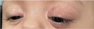Left exophthalmos.