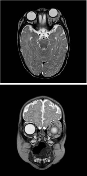 Orbital lesion compatible with hemangioma.