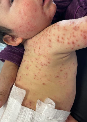 Multiple erythematous vesicles, erosions, and crusted papules on the face and trunk with background eczematous skin, two days after rash onset.