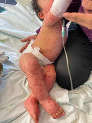 Generalized papulovesicular eruption with confluence on the trunk, two days after rash onset.