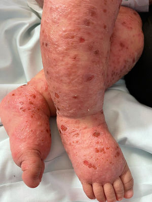 Vesicles and erythematous macules on the soles, consistent with atypical hand, foot, and mouth disease distribution, two days after rash onset.