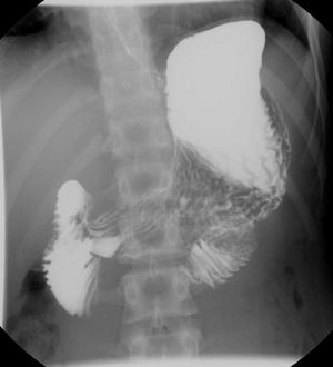 Barium swallow with patient in supine position.
