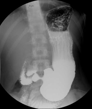 Barium swallow with patient standing.