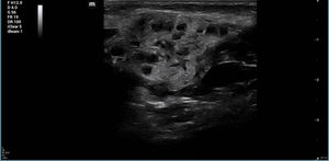 Ultrasound image showing intraglandular sialectasis in the characteristic pattern known as the pomegranate sign, compatible with acute parotitis.