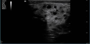 Ultrasound image showing intraglandular sialectasis in the characteristic pattern known as the pomegranate sign, compatible with acute parotitis.