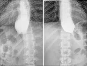 Esophagogram: esophageal dilation with the distal tapering (bird’s beak) characteristic of achalasia.