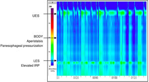 Esophageal manometry: findings consistent with achalasia, intermediate between types II and I in the Chicago Classification. Complete absence of peristalsis in the esophageal body in 100% of swallows. Elevated integrated relaxation pressure (IRP) at the esophagogastric junction (EGJ) indicating incomplete relaxation of the lower esophageal sphincter (LES). In some swallows, especially with the patient in the upright position, there was evidence of panesophageal pressurization, defined as a uniform increase in intraluminal pressure throughout the esophageal body, and typical of type II achalasia. The co-occurrence of aperistalsis and inconsistent panesophageal pressurization suggests progression from achalasia type II toward type I. Normal basal pressure at the upper esophageal sphincter (UES), with adequate relaxation and preserved pharyngoesophageal coordination.