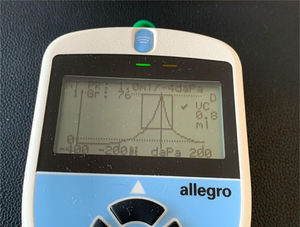 Handheld tympanometer showing a normal curve (individual observation).