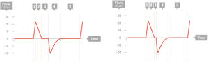 Pressure control. Flow-time curve. Segment 1: Inspiratory flow peak. Segment 2: Decelerating inspiratory flow. Segment 3: Zero flow. This pause is not preset. If there is not at least a minimum amount of time at zero flow, it is not certain whether the pressure contributes to the tidal volume. Segment 4: Effective expiratory flow. Segment 5: Zero flow at the end of expiration.