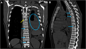 Computed tomography (CT) scan of the thoracic spine in bone window. (A) Coronal view showing moderate pleural effusion on the left side (circle) and multiple sharply demarcated lytic lesions, predominantly in vertebral bodies (blue arrows), one of them with cortical erosion (yellow arrow). (B) Sagittal view showing the same multiple sharply demarcated lytic lesions involving the vertebral bodies (arrows).