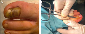 (A) Preoperative appearance of the affected nail. Proximal elevation of the nail with periungual erythema. (B) Surgical management with total proximal nail avulsion.