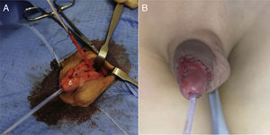 (A) Surgical intervention: dissection and removal of duplicated urethra. (B) Postoperative outcome.