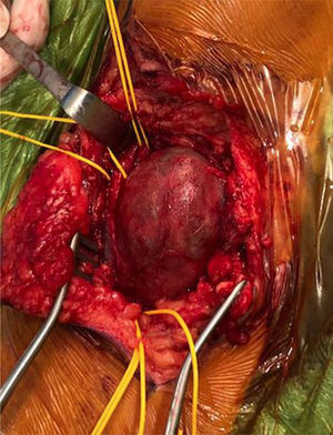 Intact saccular aneurysm of the popliteal artery, dissected proximal and distal segments of the artery with normal calibre.