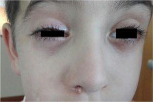 Prominent cranial autonomic features (ptosis, conjunctival injection, lachrymation and rhinorrhoea), unilateral and ipsilateral to the headaches.