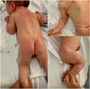 Congenital vascular lesions characteristic cutis marmorata telangiectatica congenita.