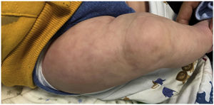 Favourable outcome with partial resolution of lesions at 4 months post birth.