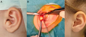 (A) Dermoid cyst in the left ear lobe. (B) Intraoperative image. (C) Outcome at 2 years.