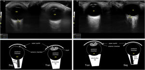 The ocular ultrasound examination is performed with the patient in the supine decubitus position with the eyes closed. At least 2 sagittal views should be obtained with the probe perpendicular to the horizontal meridian to visualize the globe and optic nerve (Sag). It is also useful to perform a transverse scan (Tran) to visualize the iris and pupil and assess the pupillary light reflex. A high-frequency (5–10MHz) linear probe is placed on the upper eyelid in the coronal plane at the level of the crystalline lens to visualize the iris, a structure surrounding an anechoic circular area that corresponds to the pupil. The images on top show both eyes in miosis upon the shining of a light through the eyelids. The “as low as reasonably achievable” (ALARA) approach must be applied to minimise thermal and mechanical indices. OD, right eye; OS, left eye.