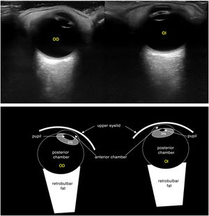 The images on the top (Tran) show the right eye in mydriasis due to the absence of light (assessment of direct and consensual reflex) and the left eye in miosis under the same conditions, evincing the absence of the pupillary light reflex, which was suggestive of inflammation in the anterior chamber (anterior uveitis). The images below provide diagrams of each of the images on top.