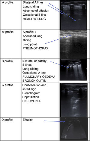 Lung ultrasound patterns based on the methodology described by Lichtenstein D. (BLUE-protocol and FALLS-protocol: Two applications of lung ultrasound in the critically ill. Chest. 2015; 147: 1659-1670) and the most frequent paediatric diseases associated with these patterns with the corresponding images.