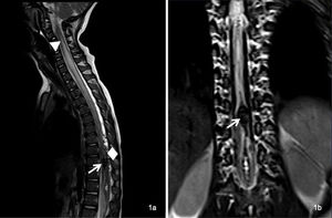 Magnetic resonance imaging of the spine revealing an intramedullary arteriovenous malformation at the D10 level (arrow), characterized by venous ectasia and haematomyelia. The haematomyelia appeared hypointense in T2-weighted imaging, extending through the central canal superiorly up to D9 and inferiorly down to the conus medullaris. At the same time, there was extensive intramedullary hyperintensity, visualized up to the level of C2, attributed to venous congestion (triangle), along with dilatation of the posterior perimedullary veins (diamond).