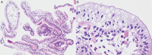 Duodenal histology. (A) Magnification ×10. Duodenal mucosa with preserved villous architecture and vacuolization of clusters of enterocytes in the apical portion of the villi (haematoxylin/eosin). (B) Magnification ×60. Vacuolization of enterocytes (haematoxylin/eosin).