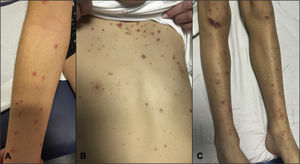 Erythematous macules and some atypical target lesions distributed through the trunk, arms, and legs.