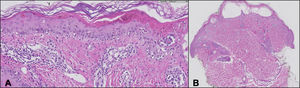 (A) (×20 magnification) Dermoepidermal detachment with vesiculation and fullthickness epidermal necrosis. (B) (×1 magnification) Interface dermatitis with basal cell vacuolization and apoptotic keratinocytes.