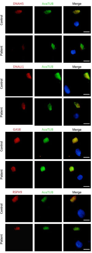 Immunofluorescence analysis of ciliary axoneme proteins in a specimen of ciliated epithelium obtained from the patient and a control specimen. Subcellular location of ciliary axoneme proteins DNAH5, DNALI1, GAS8 and RSPH9 (in red), and acetylated α-tubulin (AcαTUB, in green). The third column shows the merged channels with the nuclei stained with DAPI (in blue). DNAH5 is absent from the ciliary axoneme of the patient’s sample compared to the control sample. Scale bar: 5 μm.