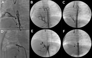 Pre- and post-occlusion angiographs of the feeding vessels of pulmonary sequestration. (A), (B), (C): Baseline aortograms of cases 1, 2 and 3. The arrows indicate the feeding vessels arising from the aorta that supplied the pulmonary sequestration. (D), (E), (F): Post-occlusion angiographs of the feeding vessels of cases 1, 2 and 3. The arrows indicate the implanted devices.