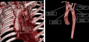 3D reconstruction of the aorta showing the cervical aortic arch and noting its branches.