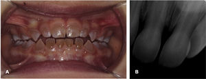 Clinical examination and radiography. (A) Clinical examination of the patient at age 27 months with complete deciduous dentition. (B) Periapical radiographs revealing obliteration of two-thirds of the pulp chambers.